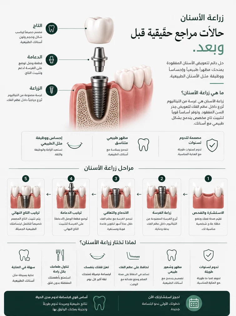 إنفوجرافيك يوضح زراعة الأسنان في عمّان مع الدكتور علي
