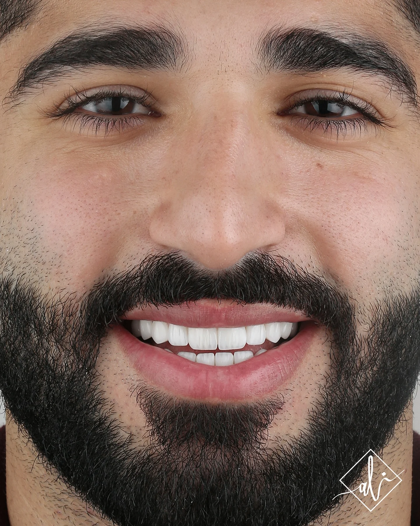 Smile shape enhancement before and after - After