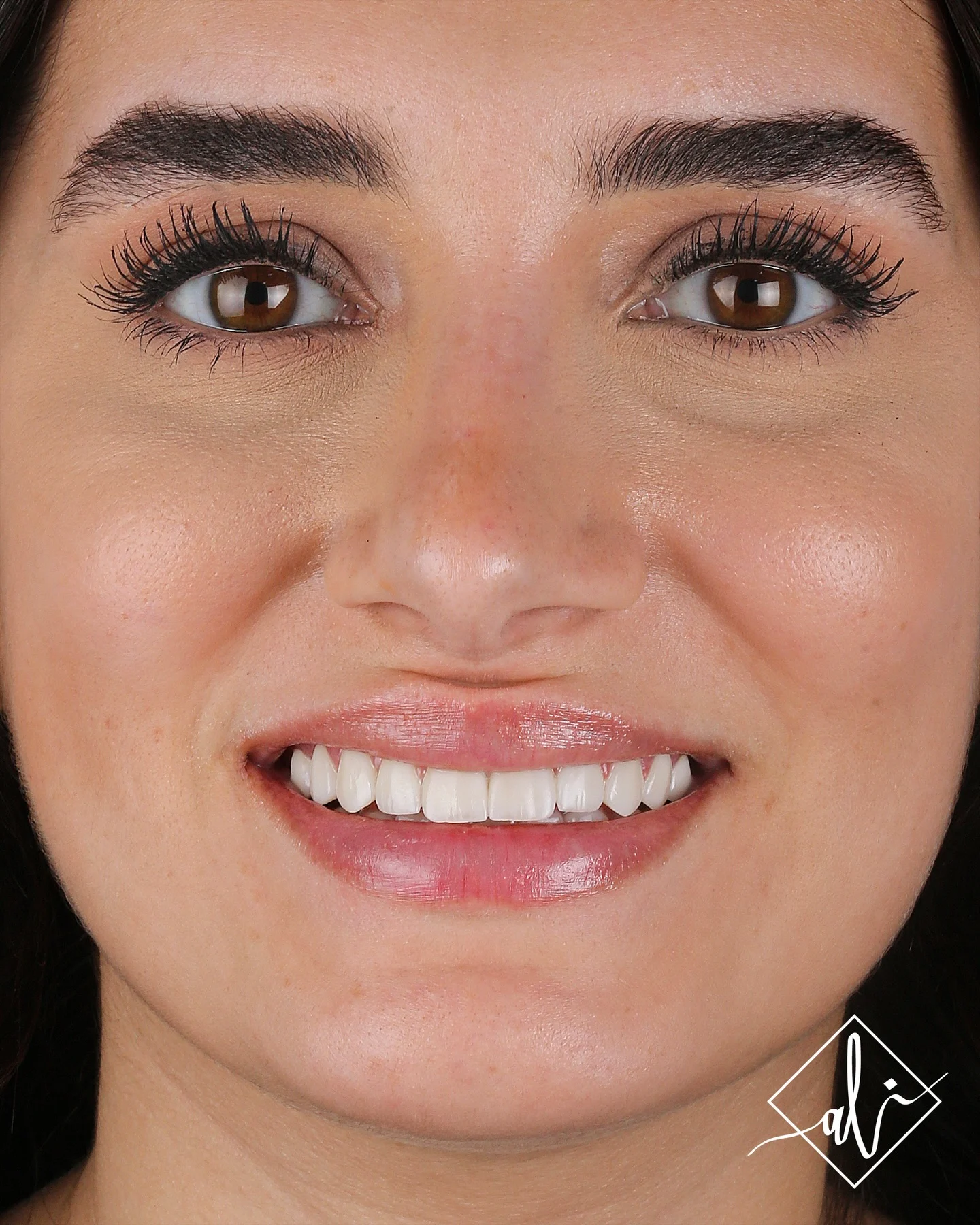 Zircon veneer result before and after - After